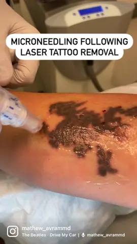 This is microneedling immediately after picosecond laser tattoo removal. The microneedling gives a means of egress for the tattoo ink particles in the skin - as can fractional resurfacing. There are many ways to help laser tattoo removal. These innovations help but complete clearance still requires many treatments regardless of the treatment modality.....#tattootreatment #microneedlingtreatment  #picosecondlaser #tattooremoval #lasertattooremoval #inkremoval #lasertreatment