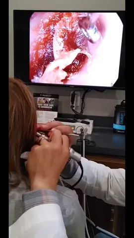⚠️Gooey wax removal PART 1 #aaron #satisfying #asmr #huh #theearboss #ear #tx #earwax  #coldestpartner #coldest @thecoldestwater