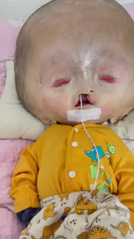 #ad  doakan bilLal yer acik2....#bilalyusra #anaksyurga #holoprosencephaly #alobarholoprosencephaly #senyumselagimampu
