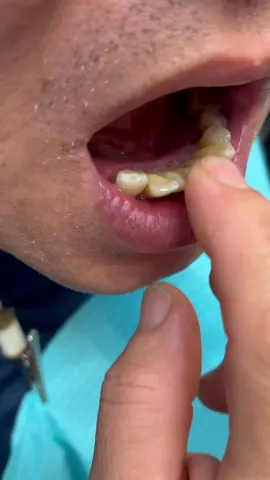 *patient gave permission to share* Severe periodontal disease causes bone loss and wiggly teeth.