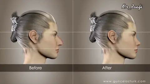 nose job #doctor #doctorsoftiktok #fyp #foryoupage #foryou #viral #viralvideos #medical #medico #wow #entertainment #education #3d #animation #surgery