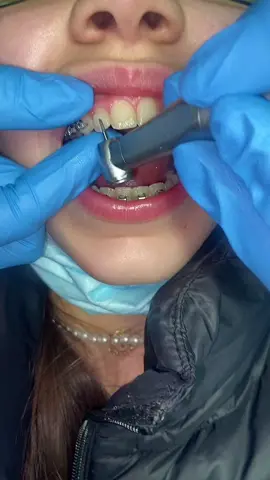 How the Orthodontist removes your brace glue👀 #bracesoff #orthodontist #braces #bracesmanchester #orthodontistmanchester #ortho #orthodonticspecialist