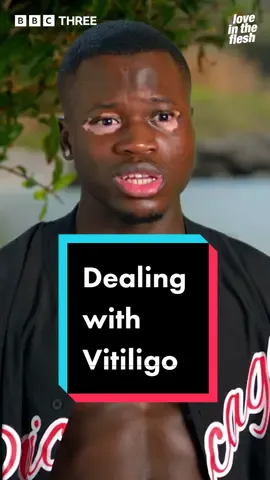 It’s Chibz’ world and we’re just living in it. #LoveInTheFlesh #vitiligo #fyp #foryoupage #threetok