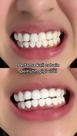 gigi kalian harus glowup juga😱✔️ #WouldYouLoveYou #breylee #breyleewhitening #gigiputih  #sponsored