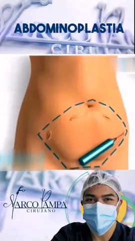 abdominoplastia #abdominoplastia #abdominoplasty #bajarrollitos #perderpeso #gordita #gordito #rollito #tummytuck #tiktok #viral #foryou #estetica