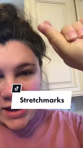 Did anyone else get raised stretch marks? #stretchmarks #stretchmarksarebeautiful #tigerstripes #pregnancyupdate #pregnant