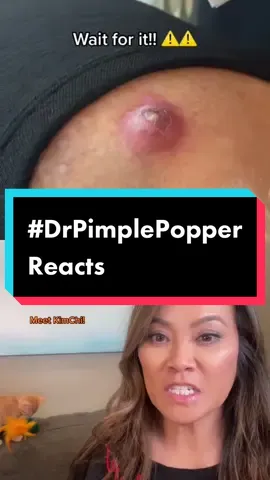 #duet with @its.kayla.layne inflamed cyst. Happy you have gloves, hope that’s at least a fresh new paper towel… and I hope that cyst didn’t grow back 🤞🏼😬#drpimplepopper #SLMDskincare