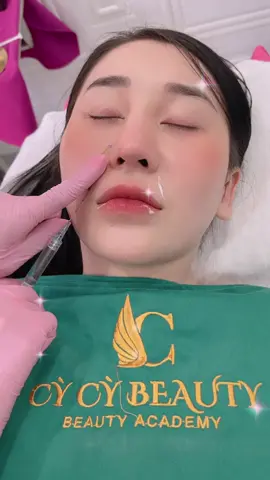 Làm đầy rãnh cười cho bé đẹp ❤ bằng kim canula ko đau ✌️