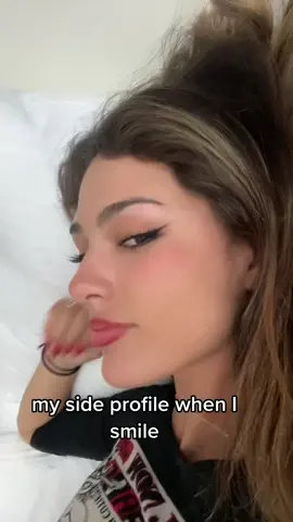 one year since I broke my nose and it finally looks normal to me again