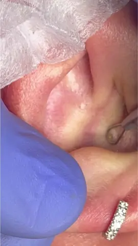 Puntos negros dentro de orejas #parati #foryou #blackhead
