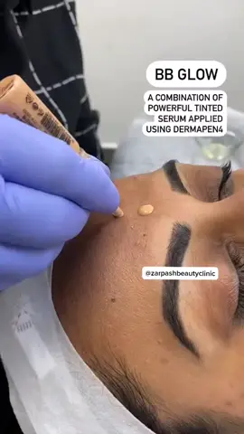 Life can’t be perfect, but your skin can be 😍BB Glow is an intensive semi-permanent skin treatment. The facial includes micro-needling with pigmented vitamin serum into your skinAs a result, you will get brightening and balancing skin tone with an overall radiant complexion. This fantastic treatment is incredibly safe and doesn't go far into the skin#skin#skinroutine#skincare#dermatology#dermatologist#botoxfiller#skinclinic#lahore #acneskincare #wrinkles#dermapen4#botox#zarpashbeautyclinic