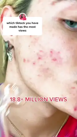 #answer to @spidermark790 my skin is forever burned… 😳😭 #foryou