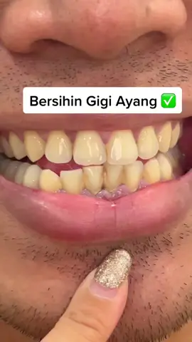 Bersihin gigi ayang ⭐️⭐️⭐️⭐️⭐️ #teethwhitening #teethcare #breyleewhitening