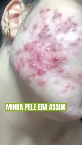 TIVE A PELE ASSIM E HOJE SÓ MANCHAS sem usar remédios #espinhasecravos #acne #espinhas #cravoseespinhas #pelesaudavel #skincare