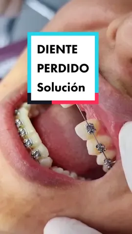 Confección de diente provisional #dienteperdido #dentista #ortodoncista #ortodonciab #brackets #toothloss #braces #viral #odontologia #dentistaentiktok