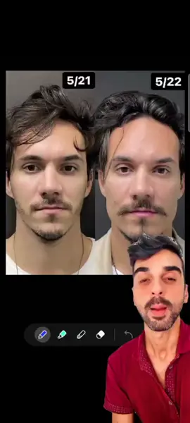 Você viu o antes e depois do Eliezer do BBB22? Vamos analisar juntos? Já me segue para o próximo vídeo #viral #tiktok #harmonicacaofacial #eliezerbbb22