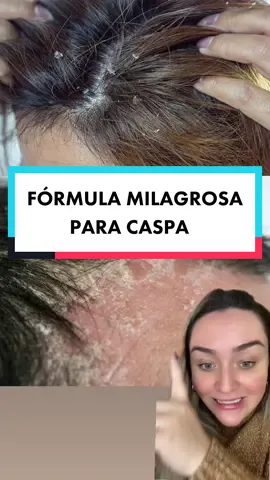 Vai por mim: é milagrosa real! #fyp #foryou #foryoupage #skincare #caspa #hair #haircare #haircareroutine #oleosessenciais #oiltherapy #aromatherapy