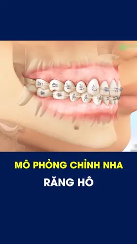 Mô phỏng chỉnh nha răng hô #nhakhoahungvuong #nhakhoaphutho #dcgr #chinhnha #chinhnharangho