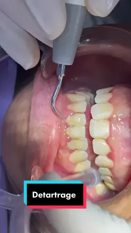 #detartrage #hygiene #dental #teeth #hollywoodsmile #healthy #gum #dentiste #dentista #viral #fyp