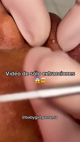 Mi parte favorita de mi trabajo 😍 #fyp #fy #extractions #pimple #pimplepop #pimplepopper