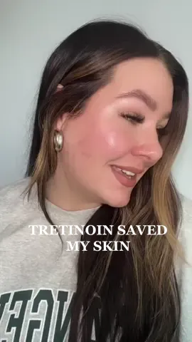 NURX 🤝 Tretinoin - a dream team who helped me clear up my skin tremendously! So thankful 🥺 #myhappiestskin #NurxPartner @Nurxapp