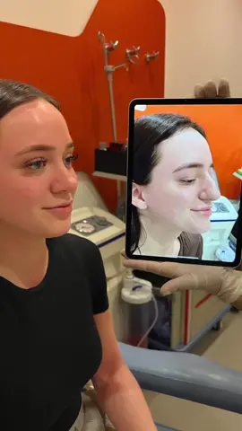 Super thick skin and crooked nose 👉 short-term result of #thickskinrhinoplasty 👉 healing process continues 👉 we are happy already and waiting for final results ✌️our lovely patient is from UK 🇬🇧 #rhino #nose #nosesurgeryturkey  #nosework #nosejobbeforeandafter #ultrasonicrinoplasti #aesthetics