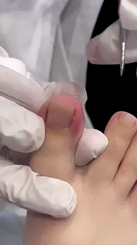 #toe #toenail #pedicure #pedicuredoctor #paronychia #share #fyp #foottherapist #foot