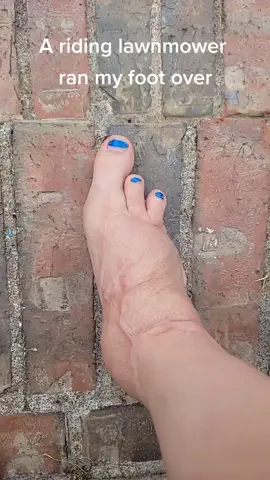 #missingtoes #fyp #almostdied #foot #lawnmoweraccident #skingraph #surgery #scar #askquestionsifyouwanttoknow #storytime