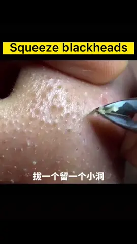 Do you clean blackheads on your face like this ? #asmr #asmrvideo #cleaningtiktok #asmrsounds #cleaning #asmrtiktoks #makeup #nose #nosecleaning #face #facecleaning #blackhead
