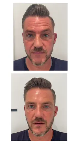 Before and after male botox by @Daniel Dimovski 💉🩺  Deep expression lines can age the face. Softening the lines while maintaining natural expression 🙋🏽‍♂️  #injectables #fillers #btx #nonsurgical #wrinkle #rimpels #plasticsurgerygent #sarasinclinic #doctors #doctorsofinstagram #belgium #hyaluronicacid #fillerlips #beauty #specialist #sarasinclinic #smooth #injectablespecialist #before #after #beforeandafter #antiaging #youthful #young #beautiful #sintmartenslatem #gent #malebotox #menbotox