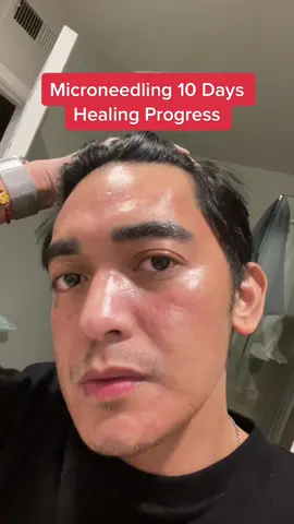 #Microneedling 10 days healing progress ✨ #skincare #licensedaesthetician #skincarebyraph #skincarephilippines #acnescars