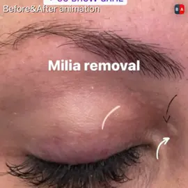 Milia removal with plasmalift. #plasmapentreatment #MadewithKAContest #plasmalift #fibroblast #fibroblasting #fibroblastspecialist #fibroblasttraining