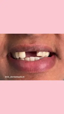 Check out our bio for info 🙏🏾 #trinidadtiktok #trinidaddentist #cbdentalstudio #trinidadandtobago #dentist #smile