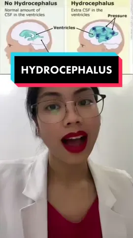 Doc Paola talks about hydrocephalus. Let's listen! 👩🏻‍⚕️🧠✨ #EduWow #EduTok #HealhTok #MedTok #edutokph #fyp This video is based on the medical professional’s assessment and is not to be interpreted as KonsultaMD’s position or as medical advice.