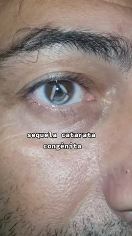 Sequela de catarata congênita #curiosidades #oftalmologia #oftalmologista #olho #eye #olhos #medicina