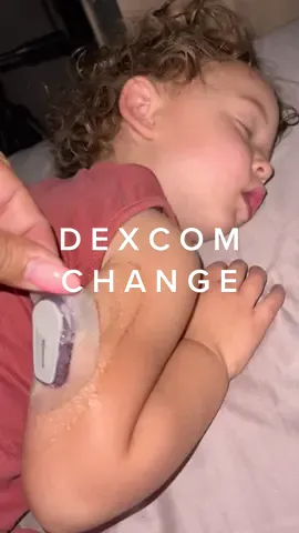 She’s OUT! Removing dexcom last night #t1d #type1diabetes #diabetictoddler #sensor #type1 #t1dtoddler #diabeticwarrior #t1dmom #dexcom #skingrip #diabetes #dexcomwarrior #toddlersoftiktok #fyp