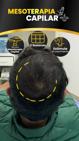 Estimula el crecimiento con mesoterapia capilar 🧔🏻‍♂️👍🏻 #mesoterapia #injertocapilar #cabello #estetica #peru #alopecia #belleza #calvicie #cuidadopersonal #tiktokperu