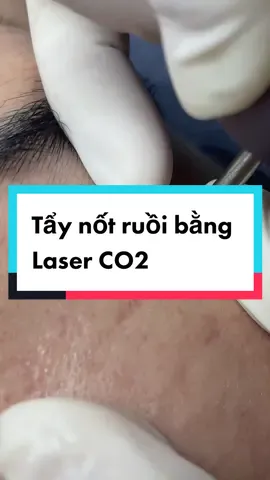 Tẩy nốt ruồi chỉ một cốc trà sữa……😘 #skincare #taynotruoi #spa