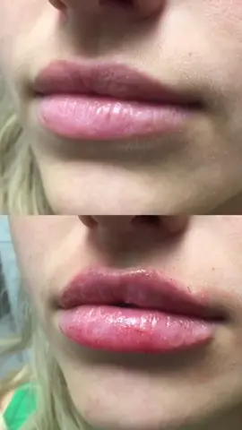 Perfect lips 👄 ✅ achieved with lip filler! Who’s getting theirs done next?! #lipfiller #lipinjections #seattlefiller #injections #beforeandafter #retylanekysse #seattle
