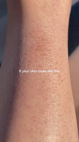 Results have me SHOOK #winterskin #dryskin #dryskintips
