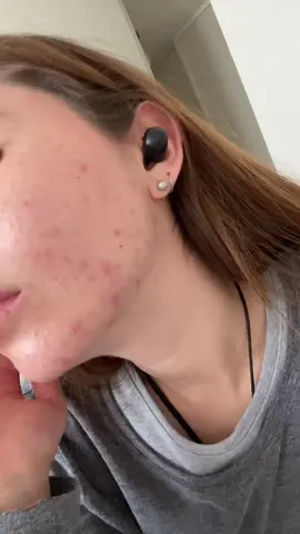 resumen de un primer (duro) mes tomando #isotretinoina #acne #chile