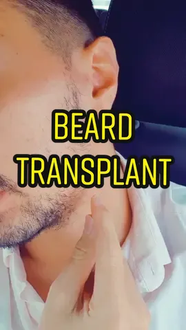 finally decided to get a beard transplant. follow for updates and ask any questions in the comments #beardtransplant #beard #transplant #hairtransplant #dubai #transformation