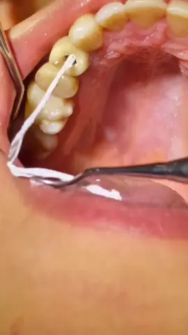 Isso não Cliclets, gente😅✌🏻#canaldente #implantedental #dentista