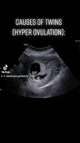 Are you a mom of multiples or singletons? #PostitAffirmations #pregnancyjourney #baby #WeStickTogether #pregnancy #ultrasound #ultrasoundtech #pregnant