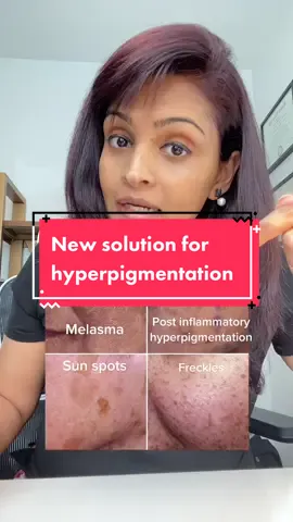 An amazing new innovative solution for hyperpigmentation coming soon! @urbanskinrx #hyperpigmentation #darkspots #melasma #acnespots #urbanskinrx