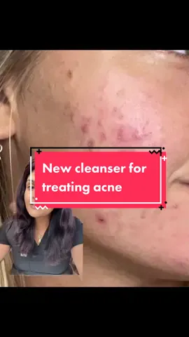 New cleanser for treating acne @Good Molecules #acne #acneroutine #acneproneskin #acnetreatment #goodmolecules #goodmoleculespartner #greenscreen