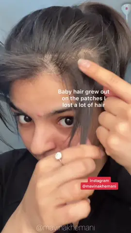 Hair growth oil which works like magic😍 #hairgrowthtips #baldpatches #hairfallsolution #hairfallproblem #hairfallremedy #hairfall #mavinakhemani #dubaimodel #uaemodel #diyhairmask #oiliveoil #castoroil #rosemaryoil #rosemarywater
