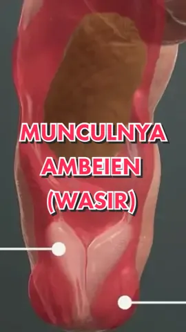 Sadar nggak sih ini beresiko kena ambeien #edukasikesehatan #kesehatan #wasir #hemorrhoids #hemoroid #ambeien #nursesoftiktok #birthcontrol #ambewas @ambewasofficial
