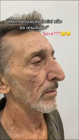 Vamos fazer?! 🤩 #harmonizacaofacial #harmonizacao #rinomodelacao #fiosdesustentacao #nariz #acidohialuronico #preenchimento