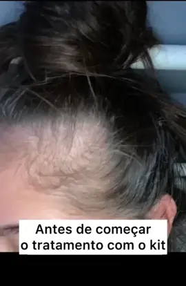 Conheça o kit SOS Crescimento ❤️ O melhor tratamento no combate à queda e no crescimento acelerado dos fios! #fy #cabelo #crescimentocapilar #quedacapilar #projetorapunzel #soscrescimento